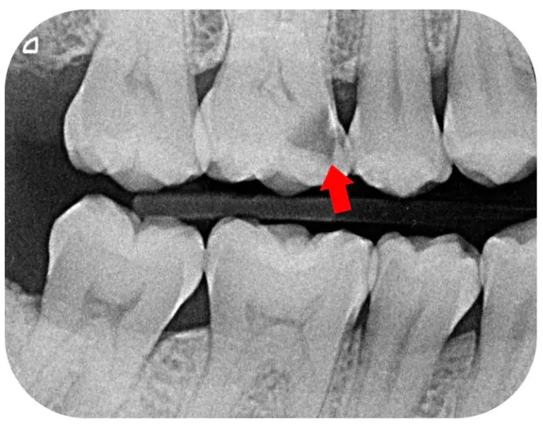 https://www.dndentalcare.com/uploads/1/2/2/0/122097430/edited/xray-caries-bw-768x601-jpg.webp?1727756036=