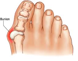 Bunion Surgery.jpg Bunion Surgery.jpg