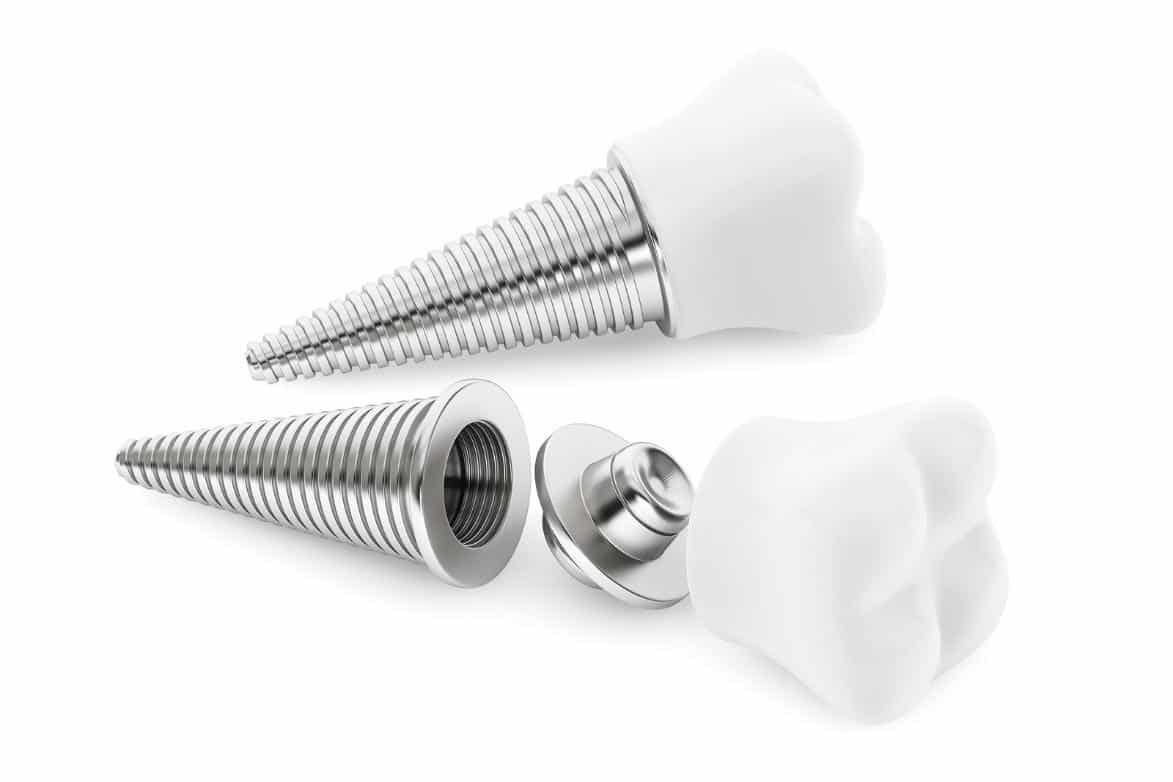 imgi_21_dental-implants.jpeg imgi_21_dental-implants.jpeg