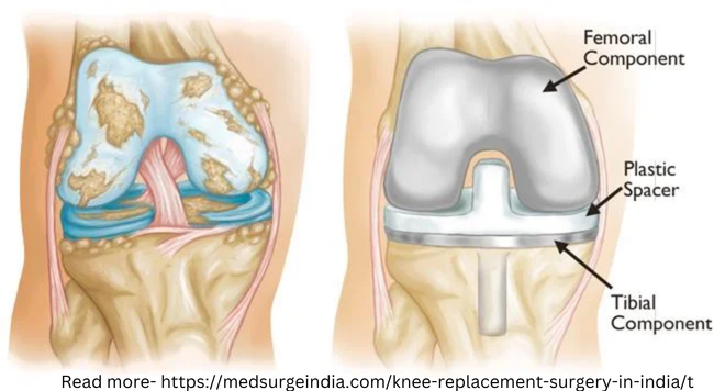 Knee replacement Surgery Cost in India.png Knee replacement Surgery Cost in India.png