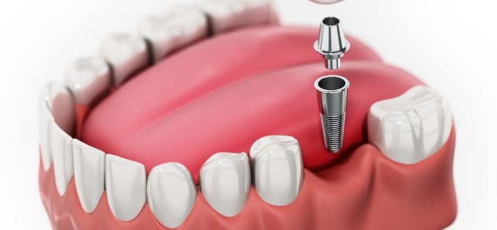 Instant Dental Implants For Tooth Loss! | Partha 130+