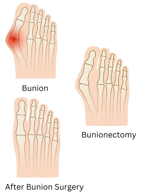 Bunion after before.png