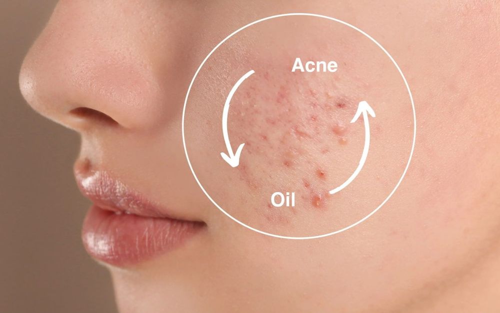 cac_buoc_skincare_cho_da_dau_mun.jpg